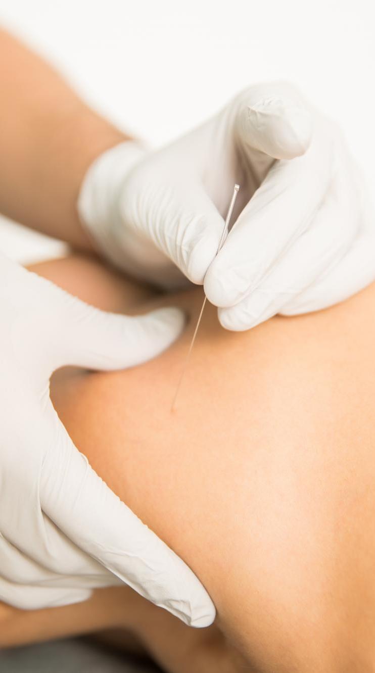 dry needling